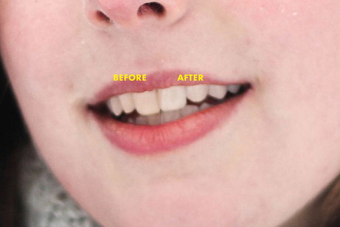 A close up portrait of a female models mouth before and after Photoshop teeth whitening